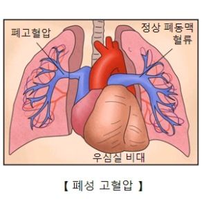 폐동맥 고혈압